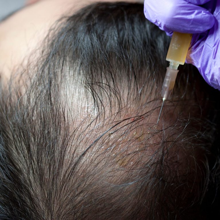 m/ درمان ریزش مو با مزوتراپی مو
